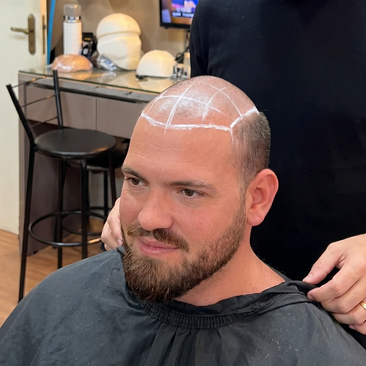 Antes da prótese capilar masculina — calvície inicial
