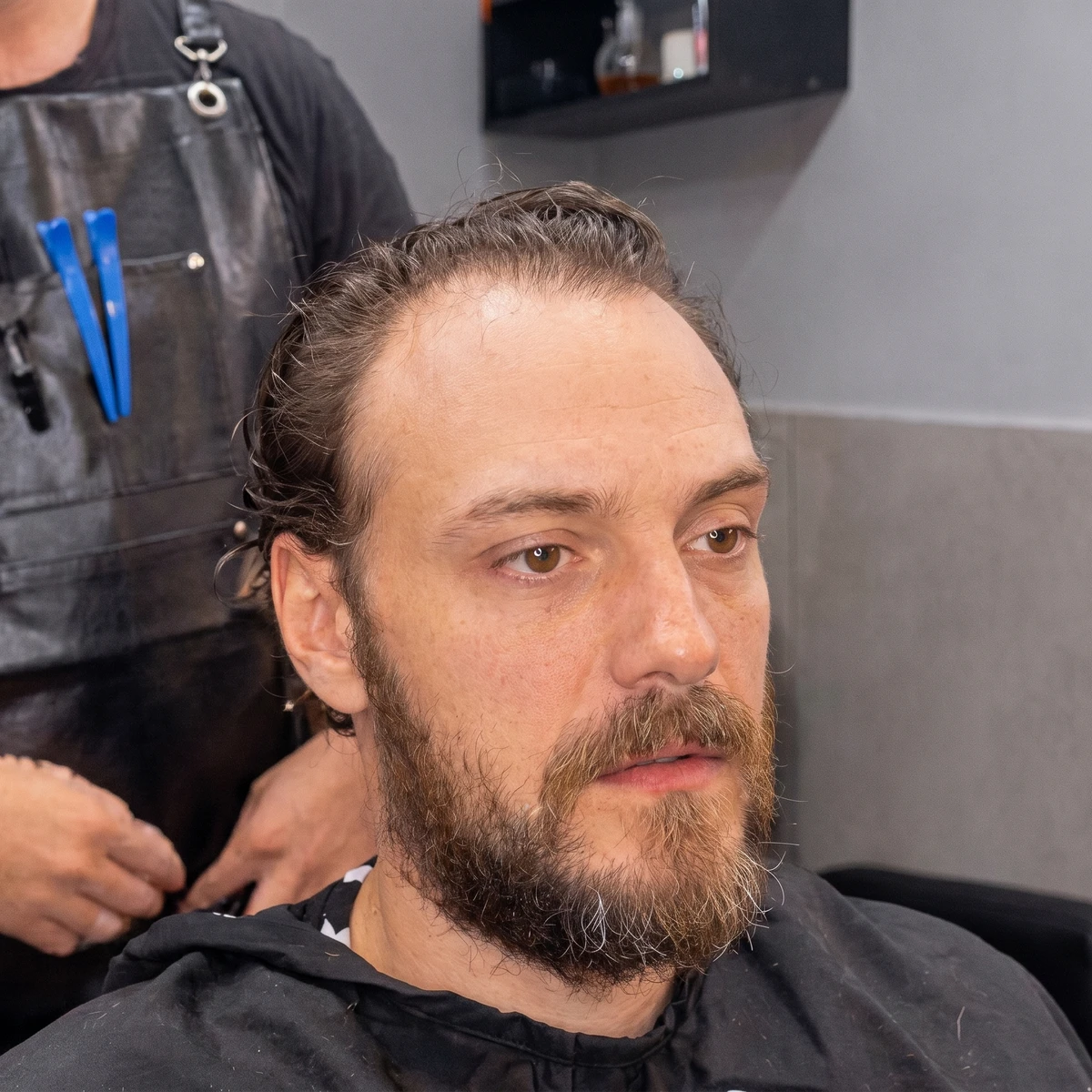 Antes da prótese capilar masculina — coroa e topo rarefeitos